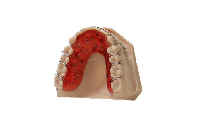 Model of the upper jaw with a fixed palatal expansion appliance (orthodontic device) attached to the teeth